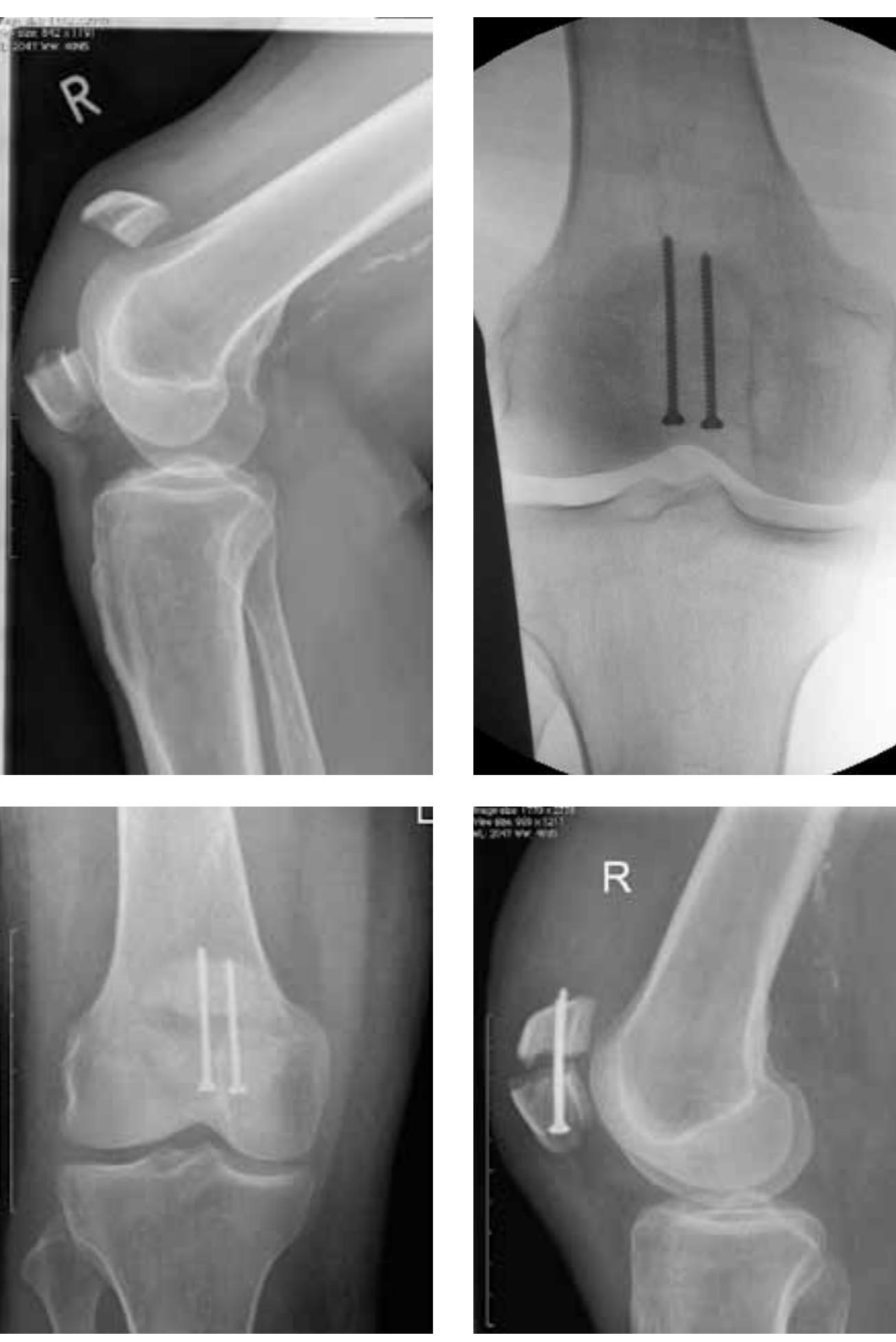 (PDF) Patellar Fractures - a Review of Classification, Genesis and ...