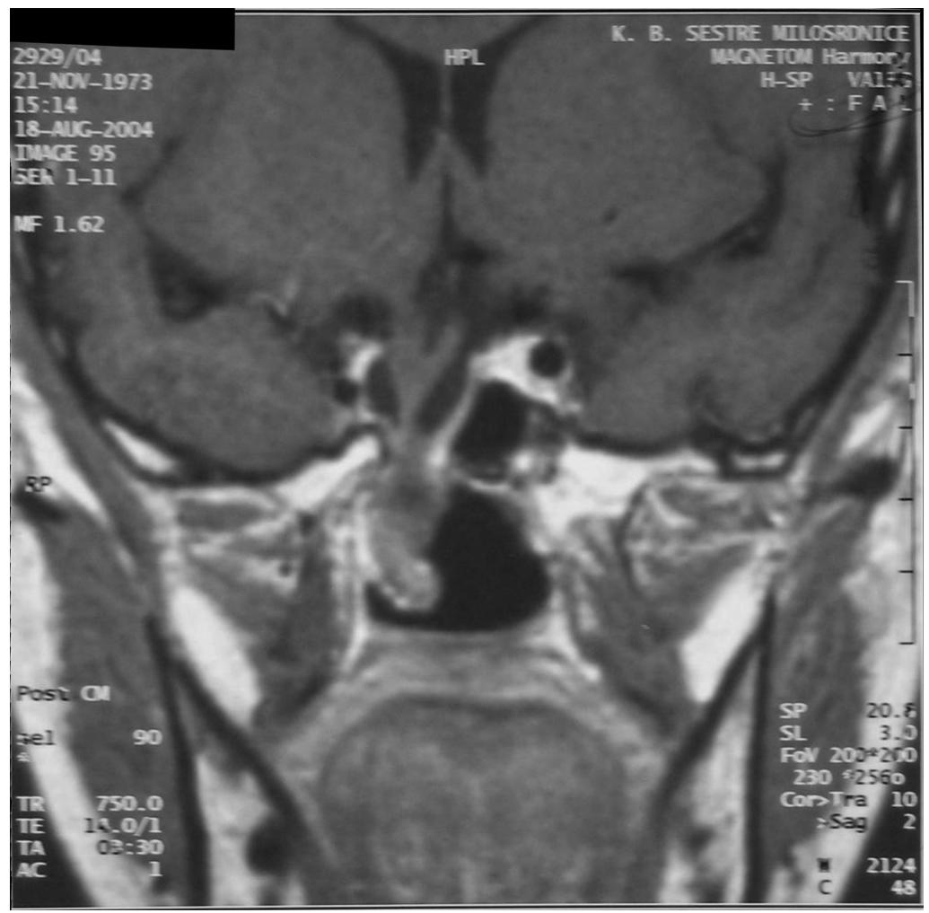 (PDF) Sphenopharyngeal Encephalocele Presenting With Partial ...