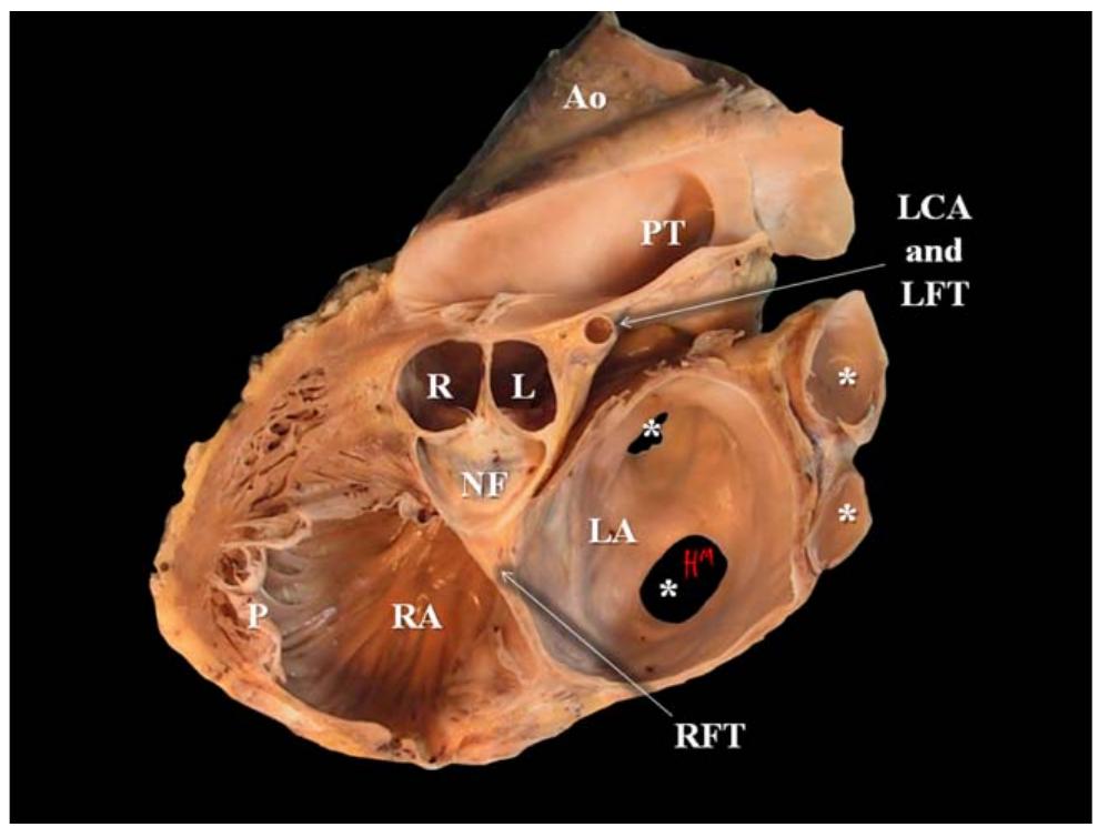 (PDF) The clinical anatomy of the right ventricle