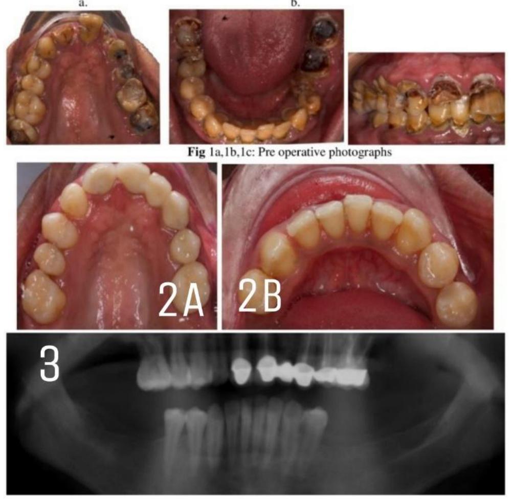 (PDF) Interdisciplinary Strategies In The Management Of A Hopeless Tooth