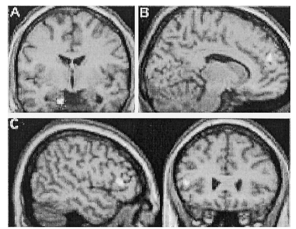 FIG. 2. Areas with significant differences of relative grey matter volume at p<0.001, superimposed onto the standard template. (A) Left amyg- dala/peri-amygdaloid cortex (—14, —5, —28): increased relative grey matter volume in the autism group (coronal cut). (B) Right paracingulate sulcus (+14, +50, +22): decreased relative grey matter volume in the autism group (sagittal cut). (C) Left inferior frontal gyrus BA 45 (—49, +26, +5): decreased relative grey matter volume in the autism group (sagittal and coronal cut). 