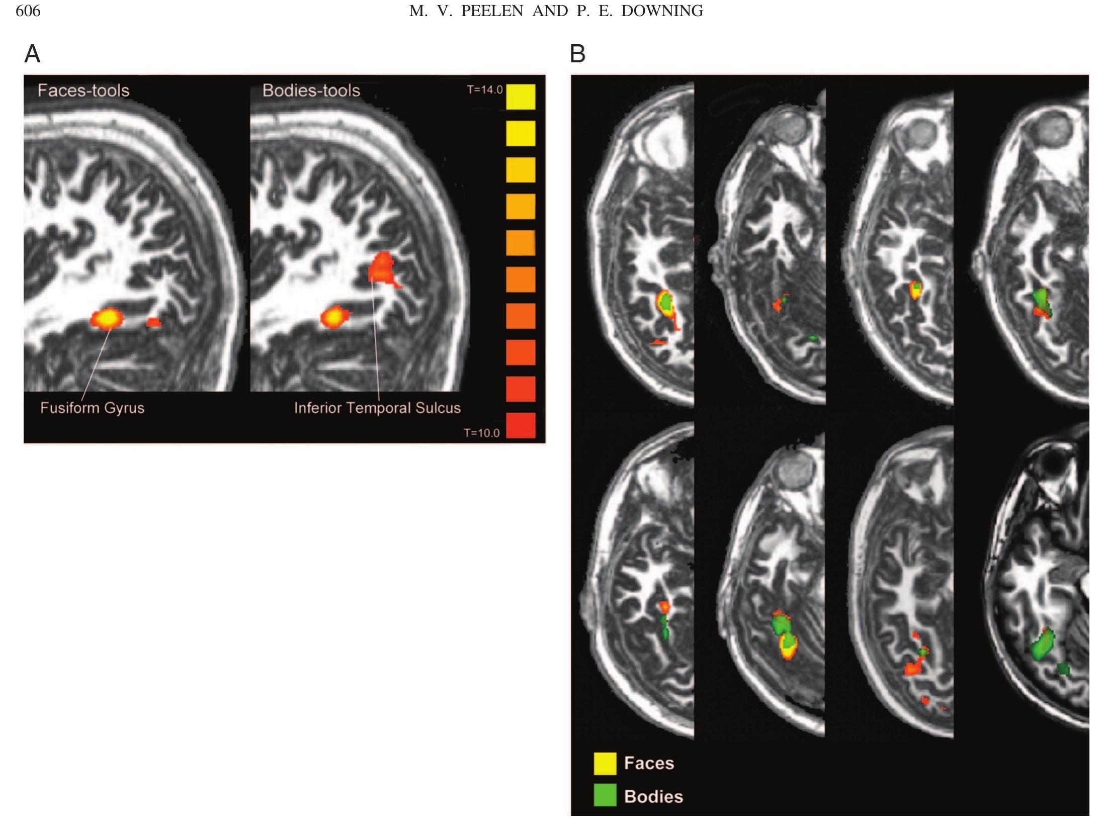A: group activation maps (t > 10) depicted on a sagittal