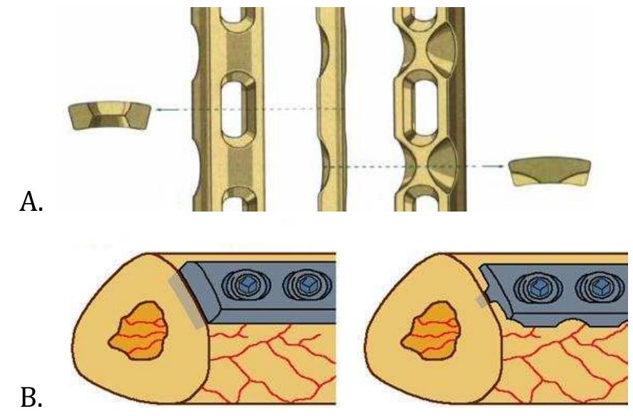 Figure 87 - from Plate Fixation in Orthopaedics