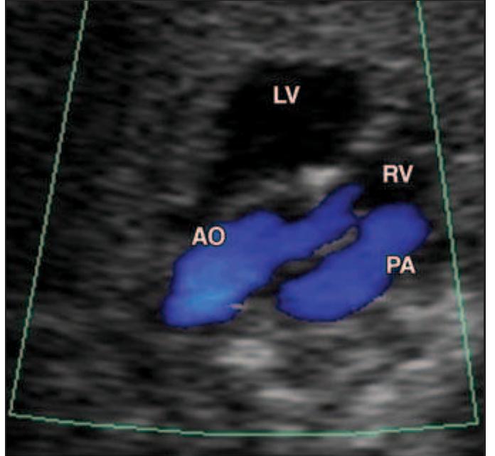 Tricular —double outlet right ventricle. right ven- tricular outlet