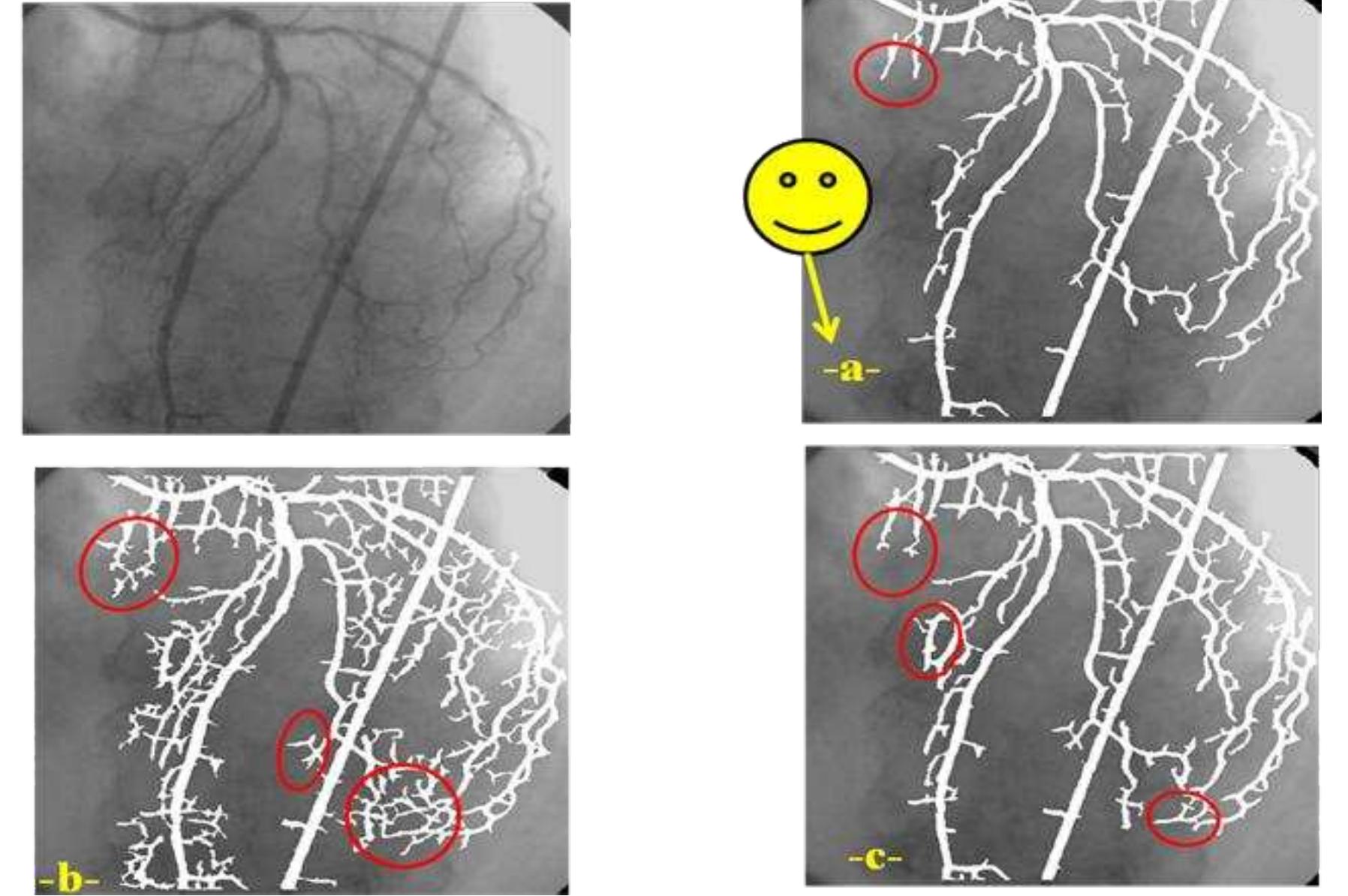 (PDF) Extraction of coronary artery trees in angiocardiography images