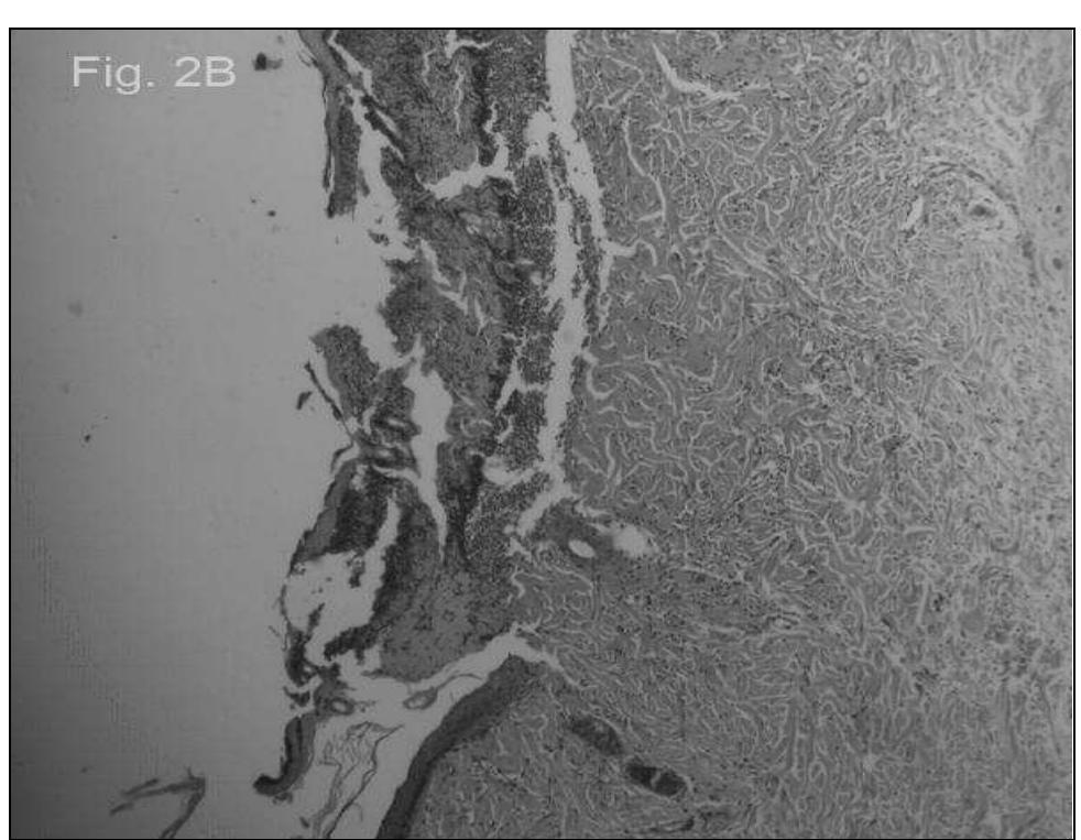 FIG. 2: PHOTOMICROGRAPH OF 4-DAY OLD BURN WOUND OF TOPICAL N.S EXTRACT OIL GROUP (A) AND CONTROL GROUP (B) H & E 200 x. (A) FOCAL EPIDERMAL REGENERATION, BURN WOUND WITH NEUTROPHILIC INFILTRATION BETWEEN VIABLE AND NON VIABLE TISSUE AND FOCAL EPIDERMAL REGENERATION; (B) BURN WOUND WITH NEUTROPHILIC INFILTRATION BETWEEN VIABLE AND NON VIABLE TISSUE, WITHOUT EPIDERMAL REGENERATION.  Values are means + S.E. for each group of six rats; * significantly different from control, P < 0.05 