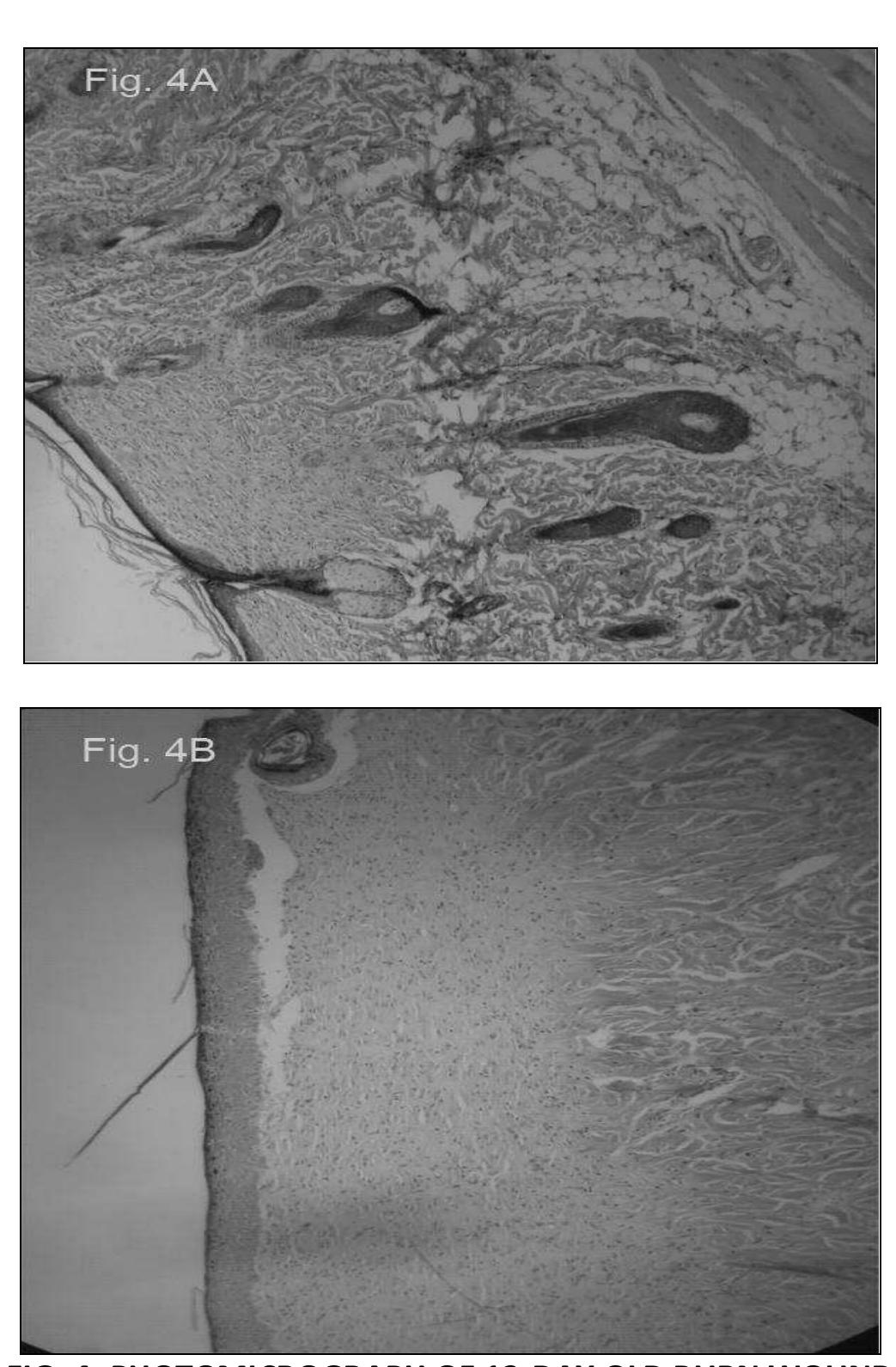 FIG. 3: PHOTOMICROGRAPH OF 8-DAY OLD BURN WOUND OF TOPICAL N.S EXTRACT OIL GROUP (A) AND CONTROL GROUP (B) H & E 200 x. (A) COMPLETELY REGENERATED EPIDERMIS WITH UNDERLYING ORGANIZING GRANULATION TISSUE AND NEW COLLAGEN BUNDLES, WITHOUT SKIN APPENDAGES; (B) THIN REGENERATED EPIDERMIS (COVERED WITH SCAR) WITH UNDERLYING GRANULATION TISSUE AND NEW COLLAGEN BUNDLES  Available online on www. ijpsr.com 