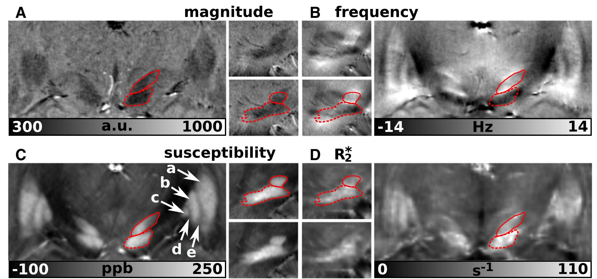 Fig. 2. Gradient-echo imaging of deep gray matter nuclei. Magnitude images and frequency, susceptibility, and R3 maps are presented in (A) to (D), respectively. The large and small subfigures represent coronal and sagittal views, respectively. The solid line indicates the subthalamic nucleus, the dashed line highlights the substantia nigra. The arrows indicate: a — putamen, b — external globus pallidus, c — internal globus pallidus, d — lamina pallidi medialis, and e — lamina pallidi lateralis. 