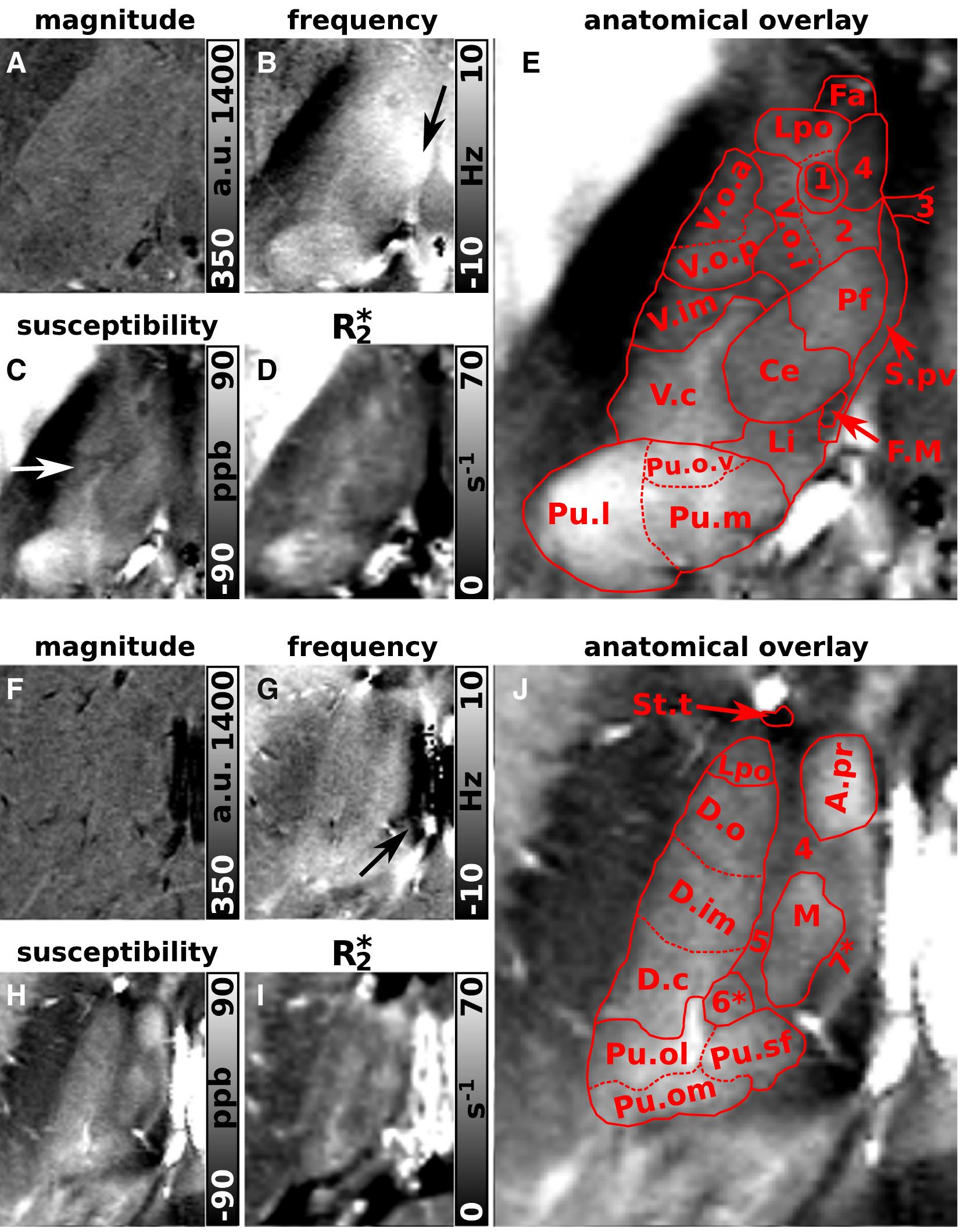 Fig. 3. Gradient-echo imaging of the thalamus. Transverse sections of magnitude, frequency, susceptibility, and R3 images are shown in (A, F), (B, G), (C, H) and (D, I), respectively. The slices presented in (A-E) and (F-J) are located 2 mm and 12.8 mm cranial to the posterior commissure, respectively. In (E) and (J) the same, but magnified susceptibility maps are presented as in (C) and (H), respectively, with anatomic overlays outlining the substructure of the thalamus according to the Schaltenbrand and Wahren atlas (Schaltenbrand et al., 1977): 3 — adhaesio interthalamica, A.pr — Ncl. anteroprincipalis thalami, Ce — Ncll. centralis thalami, D.c — Ncl. dorso-caudalis, D.im — Ncll. dorso-intermedii, D.o — Necll. dorso-orales thalami, Fa — Ncl. fasciculosus thalami, F.M — fasciculus retroflexus Meynertii, 5 =La.m.ip — lamella medialis interpolaris, 4=La.m.o — lamella medialis oralis, Li — Ncl. limitans thalami, Lpo — Ncl. lateropolaris thalami, M — Ncl. dorsomedialis, Pf — Ncl. parafascicularis thalami, Pu — Pulvinar thalami, Pu.l — Pulvinar laterale, Pum — Pulvinar mediale, Pu.o — Pulvinar orale, Pu.o.v — Pulvinar oro-ventralis, Pu.s.f — Ncl. pulvinaris superficialis, Spy — Substantia periventricularis, St.t — Stria terminalis, 1 =T.mth — Tractus mammillo-thalamicus, V.c — Ncl. ventrocaudalis, V.im — Ncl. ventrointermedius, V.o.a — Ncl. ventrooralis anterior, V.o.i — Ncl. ventrooralis internus, 2 = V.o.m. — Ncl. ventrooralis medialis, and V.o.p — Ncl. ventrooralis posterior. According to Morel et al. (1997) the following thalamic subregions were identified: 6* = CL — Ncl. centralis lateralis and 7* = LMM —  Lamina medullaris medialis. The white arrow indicates the V.im. Discrimination of thalamic nuclei in frequency images is impeded by the non-local signal contributions close to the re- gions marked by black arrows. 