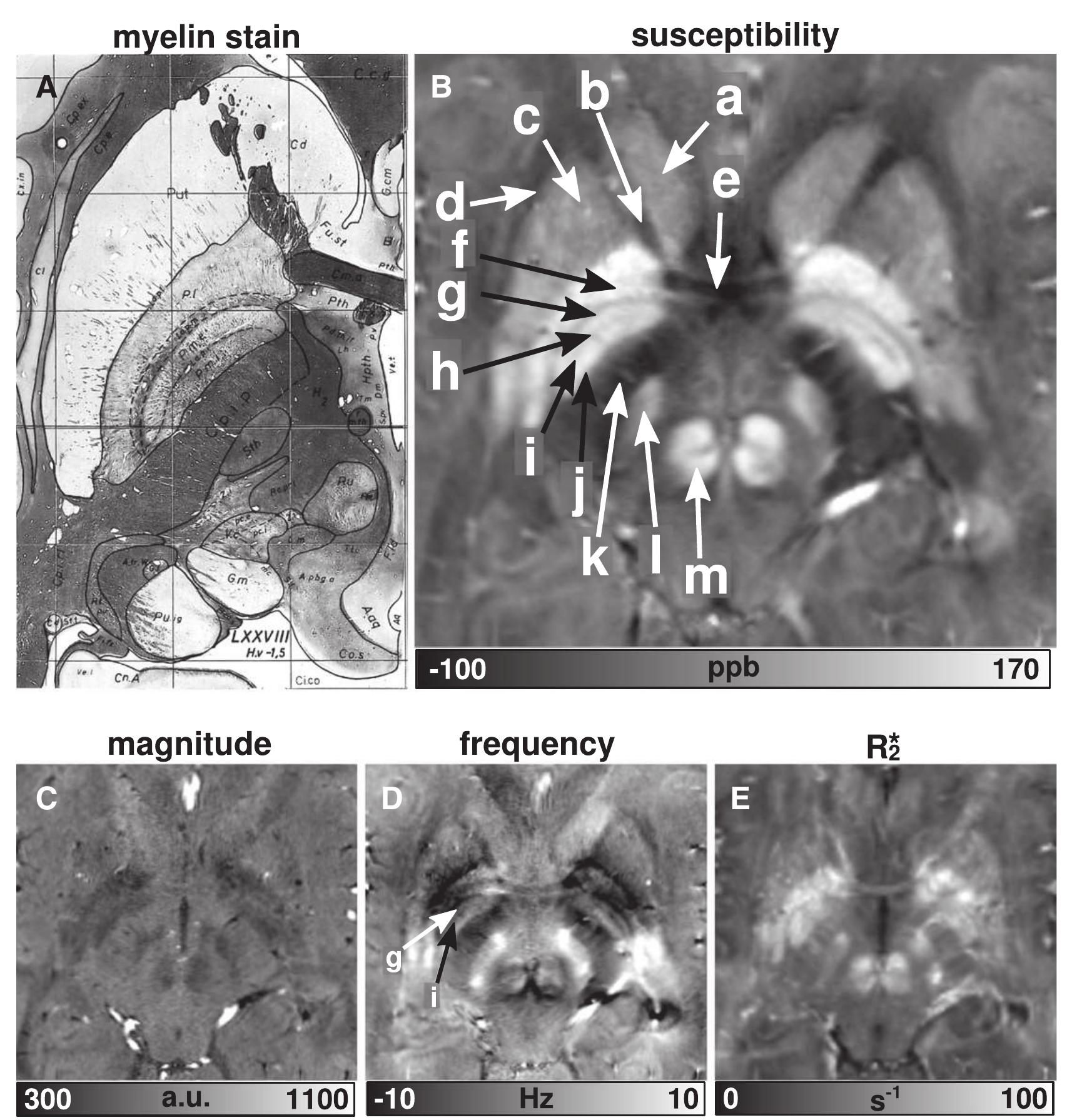 Fig. 4. Gradient-echo imaging of the basal ganglia. Transverse sections of susceptibility, magnitude, frequency, and RS images of a healthy volunteer are shown in (B) to (E), respec- tively. A horizontal myelin stain with superposed contours at the level of the internal globus pallidus (plate 54) of the Schaltenbrand and Wahren atlas (Schaltenbrand et al., 1977) is presented in (A). The susceptibility map clearly reveals: a — head of the caudate nucleus (Cd), b — anterior limb of internal capsule (Cp.i.a), c — putamen (Put), d — external capsule (Cp.e), e — anterior commissure (Cm.a), f — external globus pallidus (P.1), g — lamina pallidi medialis (La.p.m), h — pallidum mediale externum (P.m.e), i — lamina pallidi  incompleta (La.p.i), j — pallidum mediale internum (P.m.i), k — posterior limb of internal capsule (Cp.i.p), | — subthalamic nucleus (Sth), and m — red nucleus (Ru). [The myelin stain was reproduced from Schaltenbrand et al. (1977) with permission from Georg Thieme Verlag KG, Germany.]  High-resolution quantitative susceptibility mapping of the human brain was performed at 7 T and compared to GRE-based magnitude, frequency and R3 information. Due to its high sensitivity to iron and myelin, susceptibility contrast directly reflected subtle variations in tissue composition consistent with histology. It enabled the identifi- cation of several substructures of the human brain that were in part indiscernible on the other GRE-based contrasts. Furthermore, we demonstrated a non-heuristic approach for analyzing cortical subre- gions of GRE images by employing automatic cortical surface model- ing of an additional T;-weighted data set and a probabilistic atlas.  The results of univariate regression analyses of susceptibility dif- ferences and R3 are summarized in Table 4. Considering all WM, deep GM, and cortical GM regions of all subjects, R3. showed signifi- cant linear correlation with susceptibility differences (r=0.79, p<0.001). The linear correlation increased substantially when white matter regions were excluded from the analysis. The best linear cor- relation was obtained for cortical and deep GM (r=0.93, p<0.001). The scatter plot of average R3 values versus average susceptibility 