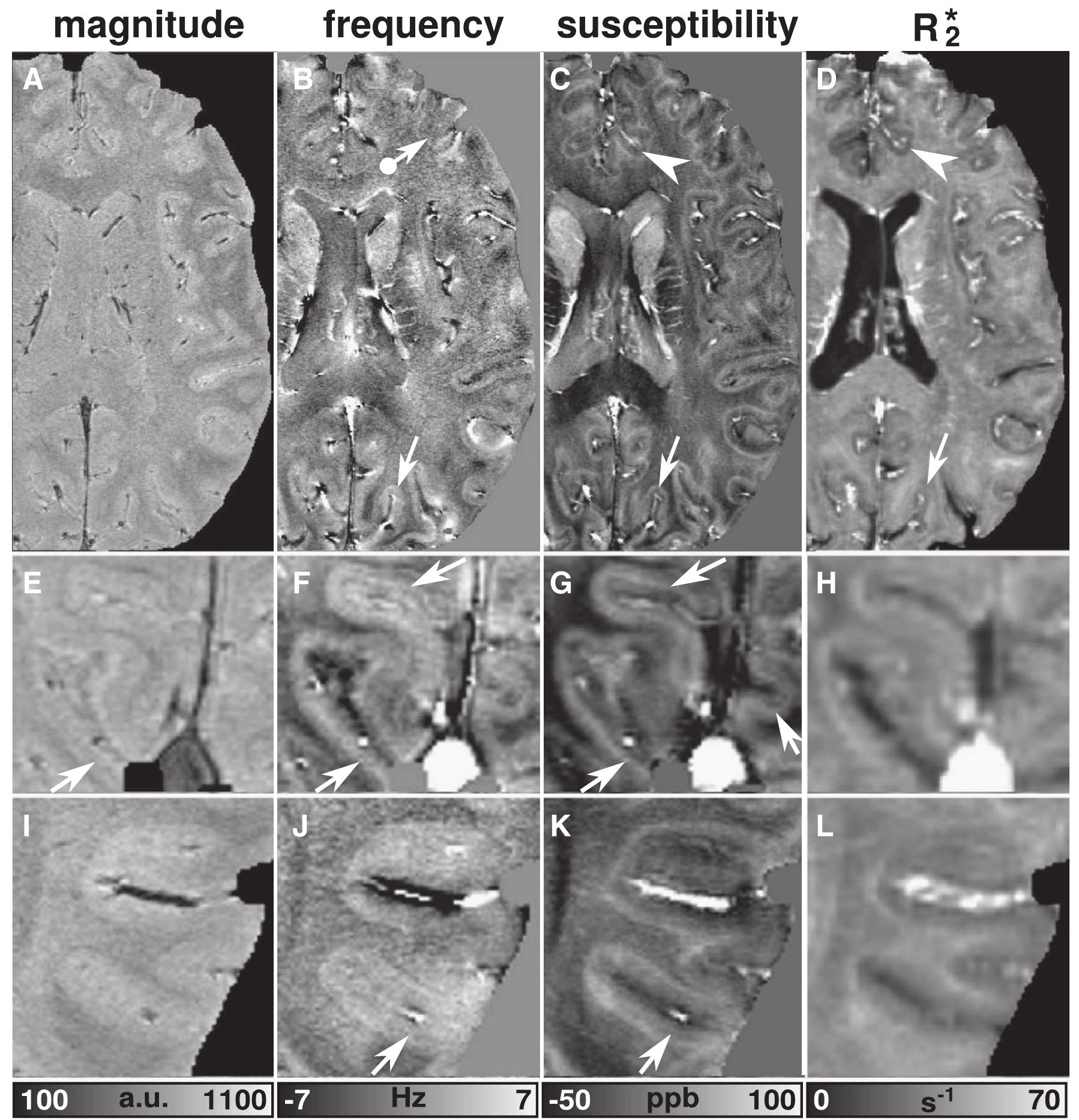 Fig. 5. Gradient-echo imaging of the cortex. Magnitude images, frequency, susceptibility, and RS maps are presented column-wise from left to right, respectively. The top row rep- resents the left hemisphere. The white arrows and arrow heads in the top row point to the parietal-occipital sulcus and to the anterior part of the cingulate gyrus and sulcus, re- spectively. The dot-ended arrow indicates a region of the frontal cortex with low frequency contrast between GM and WM. Visualizations of the visual cortex (occipital pole, calcarine sulcus, and cuneus) and the left superior temporal sulcus are shown in the middle and bottom row, respectively. The arrows in the middle row indicate a layer within the cortical GM that is hyperintense in both frequency and susceptibility maps. The arrows in the bottom row point to a hypointense layer within the cortical GM of the superior temporal sulcus. 