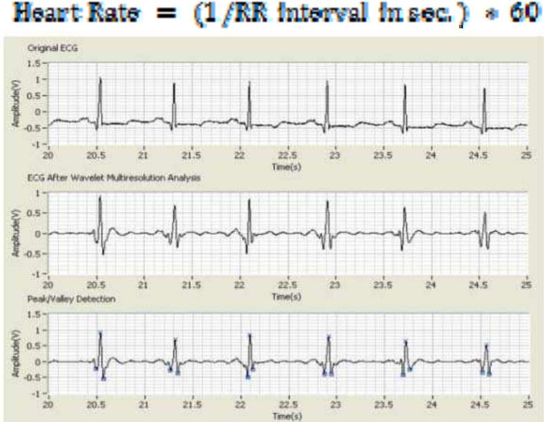 (PDF) Study and Analysis of ECG Signal Using MATLAB & LABVIEW as ...