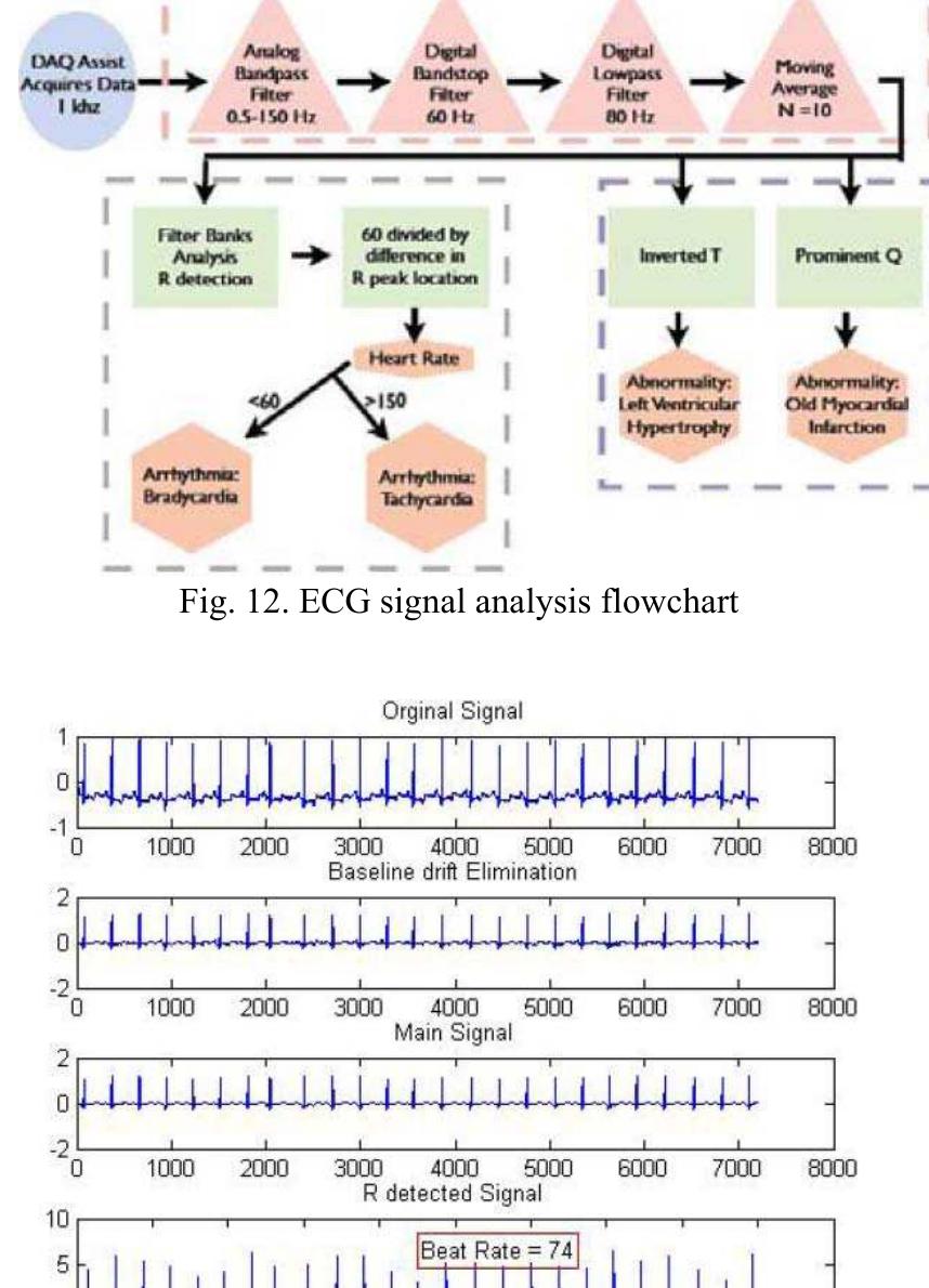 Figure 15 - Study and Analysis of ECG Signal Using MATLAB