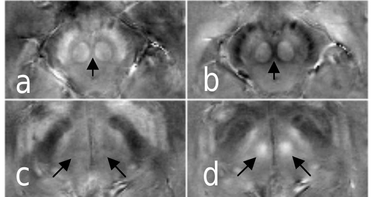a ad Valo -Ulo Velo  Figure 1: Estimation of the magnetic susceptibility in vivo for a single slice. The unwrapped phase image and RDF are shown in (a) and (b), respectively. The  corresponding susceptibility maps were calculated without shutter (c), with shutter (d) as well as with shutter and offset (f).  A———~e  Figure 1 illustrates the steps of calculation from unwrapped phase images (Fig la) to the magnetic susceptibility (Fig le) in vivo. Solving the matrix equation Ax=b without shutter and offset induced low spatial frequencies superposed on the susceptibility map (Fig 1c). Although solving SAx=b reduced these slowly varying inhomogeneities, but high frequency artefacts still remained in the susceptibility map (Fig 1d). The susceptibility map computed with shutter and offset compensation (SA’’x’=b) produced a nearly artefact free susceptibility image, However, small variations in susceptibility still occurred in the frontal brain. Extravascular field inhomogeneities in venous vessels were completely removed in the susceptibility map (see arrows in Fig 1). Another example shows that the susceptibility map accurately depicted the shape of the red nuclei (see arrows in Fig 2a and 2b) and compensates their field inhomogeneity in cranially located slices (Fig 2c and 2d).   Figure 2: The susceptibility map (a, c) and_ its corresponding RDF (b, d) map show a Slice at the location of the deep nuclei (top row) and a slice located 8mm  cranially to (a).  Discussion 