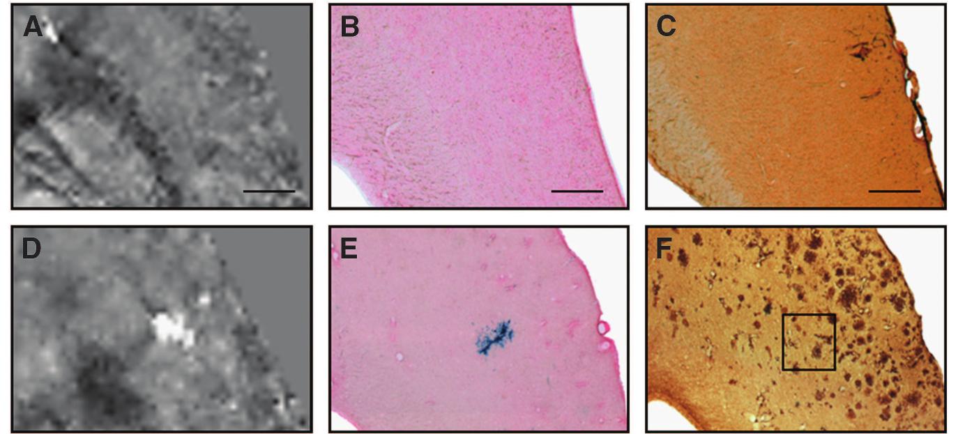Figure 6 Comparison of quantitative susceptibility maps (QSMs) of an 18-month old wild-type (A-C) and an age-matched arcAf mouse (D-F) with tissue histology. Depicted are magnified QSMs (A, D) of the cortex and the corresponding tissue sections after Prussian blue/Eosin staining (B, E) and anti-Af immunohistochemistry (C, F). A high focal iron concentration is detected in the arcAf mouse that corresponds to the area of high susceptibility in the QSM, indicating the occurrence of cerebral microbleeds. The scale bars indicate 500 um. 