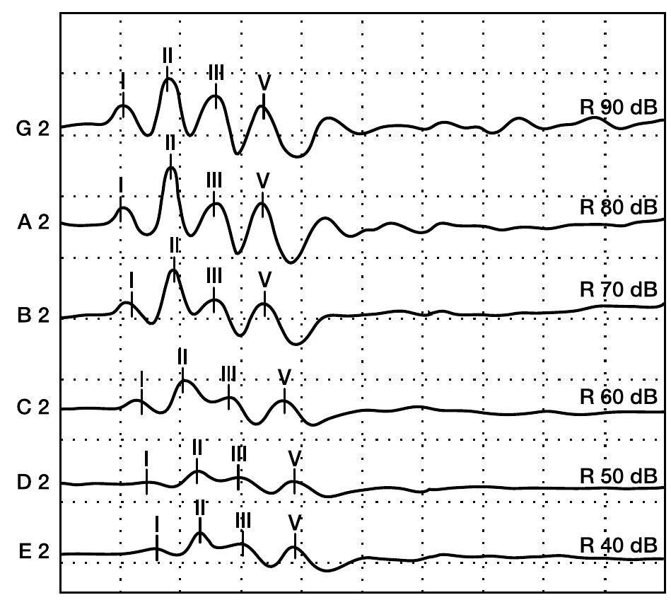 Typical morphology of brainstem auditory evoked responses