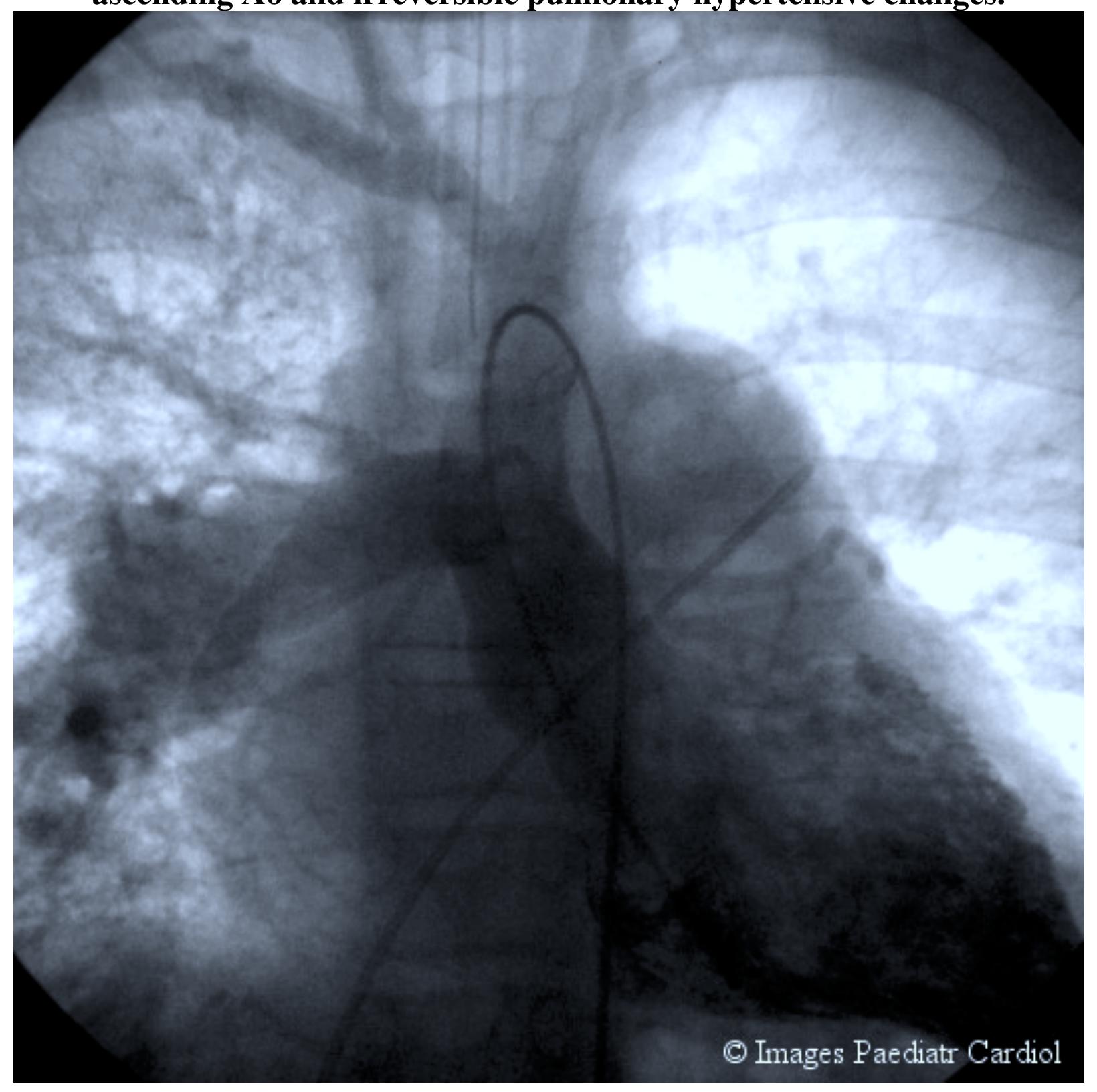 (PDF) Anomalous right pulmonary artery from the aorta. Images Paediatr ...
