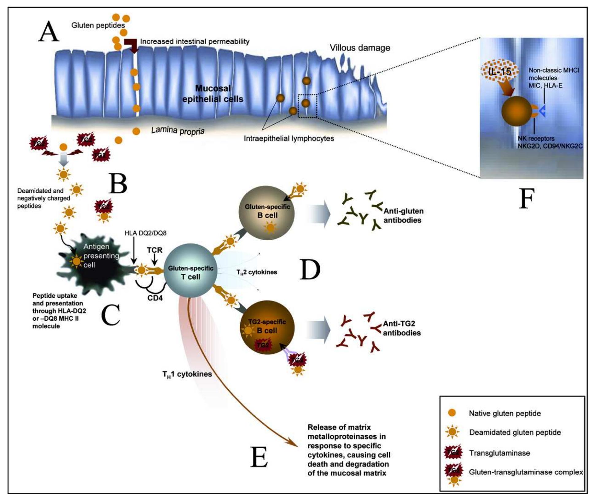 (PDF) Celiac disease From gluten to autoimmunity