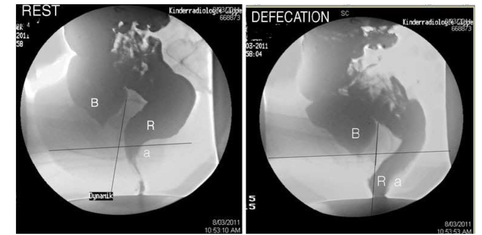 (PDF) Mechanics of Defecation 1