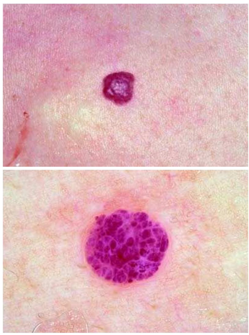 lipo c with b12 with tirzepatide Ocular Melanocytic Tumors main image 1