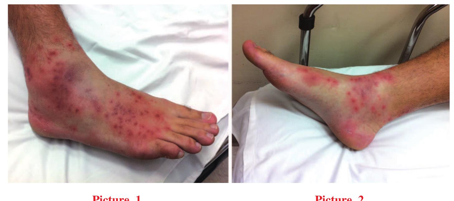Lcv Rash (PDF) Leukocytoclastic vasculitis after steroid injection