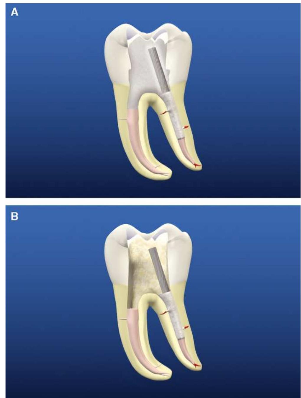 Fic 5. (a) a graphic demonstrates a mandibular molar with