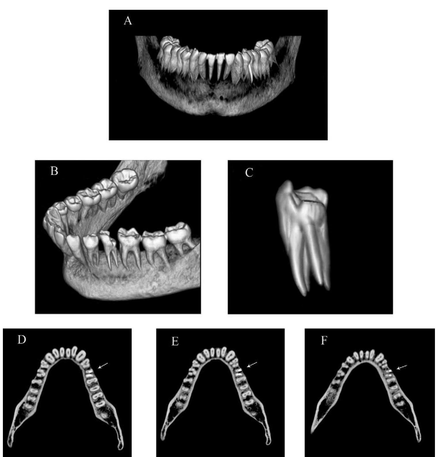 Premolar Roots Radiograph Figure 1 - from 2008 Sachdeva - Endodontic Management of a