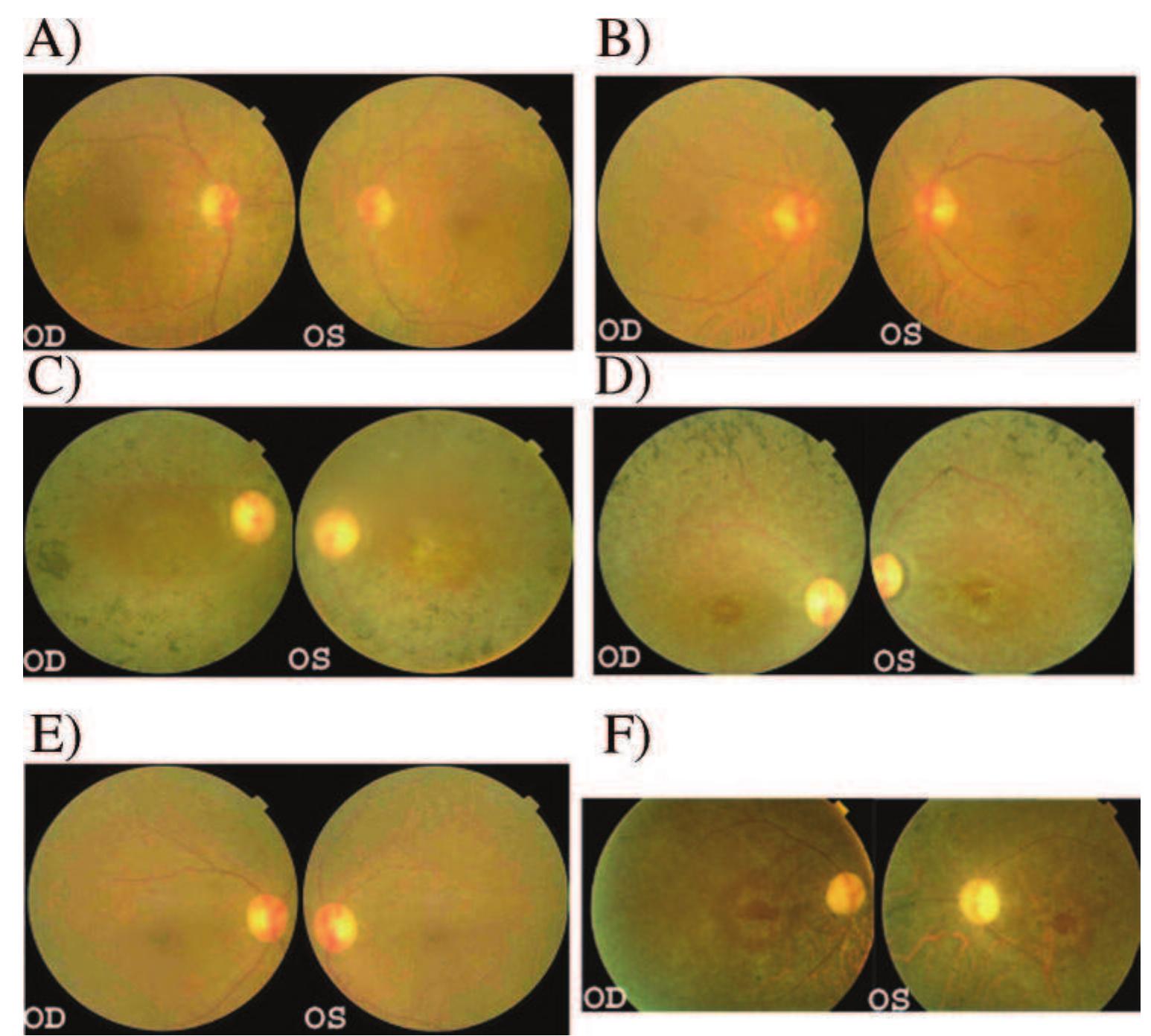 Figure 1 - Autosomal Recessive Retinitis Pigmentosa Is