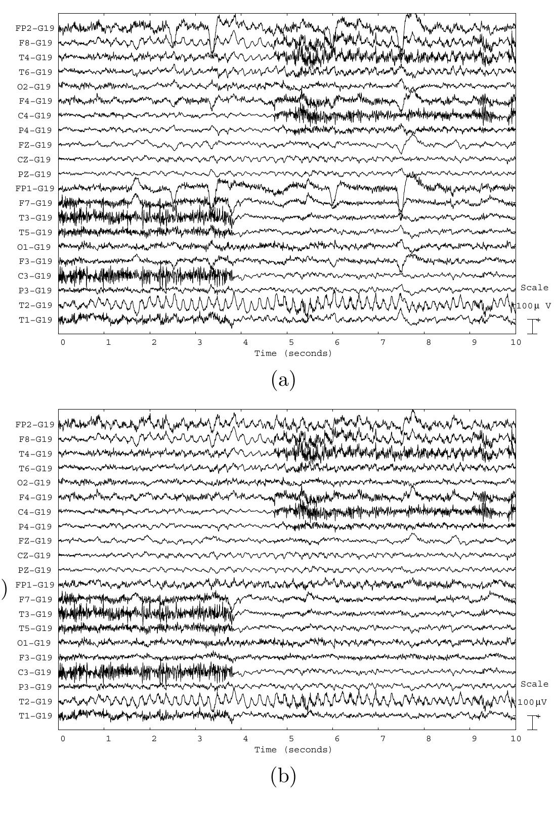 (PDF) Automatic Removal of Ocular Artifacts in the EEG without an EOG ...