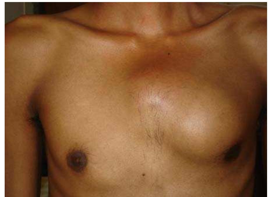Multiple Body Abscess Photograph showing the anterior chest wall swelling. found