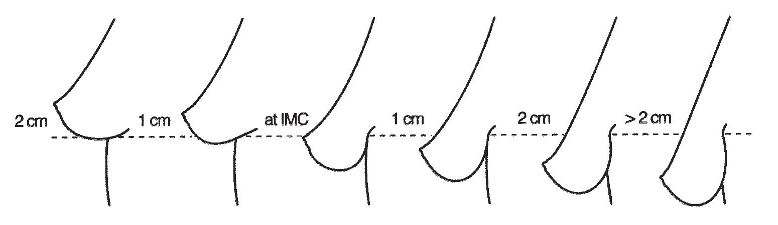 Classification of ptosis.
