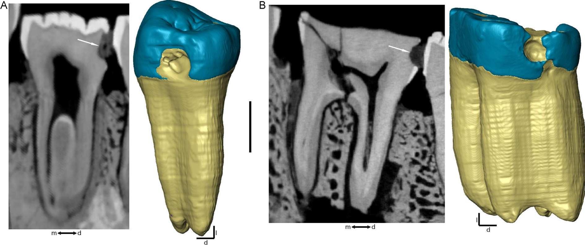 Fig. 2. Virtual mesiodistal cross-section through the central axis (left) and 3D rendering (right) of the LLP4 of Tighenif 2 (A) and of the LRM1 of Tighenif 1 (B) whose distal aspects exhibit the previously unreported evidence of a local decalcification involving both enamel and dentine (arrows), but not reaching the pulp cavity. These cavities represent in both cases an interproximal carious lesion. d: distal; |: lingual; m: mesial. Scale: 5 mm. Colour available online. Fig. 2. Section mésio-distale virtuelle passant par l’axe central (gauche) et reconstruction 3D (droite) de la LLP4 de Tighenif 2 (A) et de la LRM1 de Tighenif 1 (B), dont les faces distales montrent des décalcifications locales encore non signalées précédemment affectant |’émail et la dentine (fléches), mais  n’atteignant pas la cavité pulpaire. Ces cavités représentent dans les deux cas des lésions carieuses interproximales. d: distal; 1: lingual; m: mésial. Echelle : 5mm. Couleur disponible en ligne. 