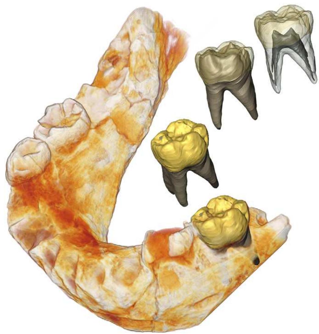 Fig. 4. Rendering of the mandible of a Neanderthal child from the site of Molare (Italy) showing the virtual extraction of the left second deciduous molar.  Fig. 3. Skull of Protenodontosaurus italicus on the rotation stage of microCT instrument in front of the flat panel sensor (A) and the 3D reconstruction of its anterior part (B) allowing virtual sections (C) for endostructural studies. 