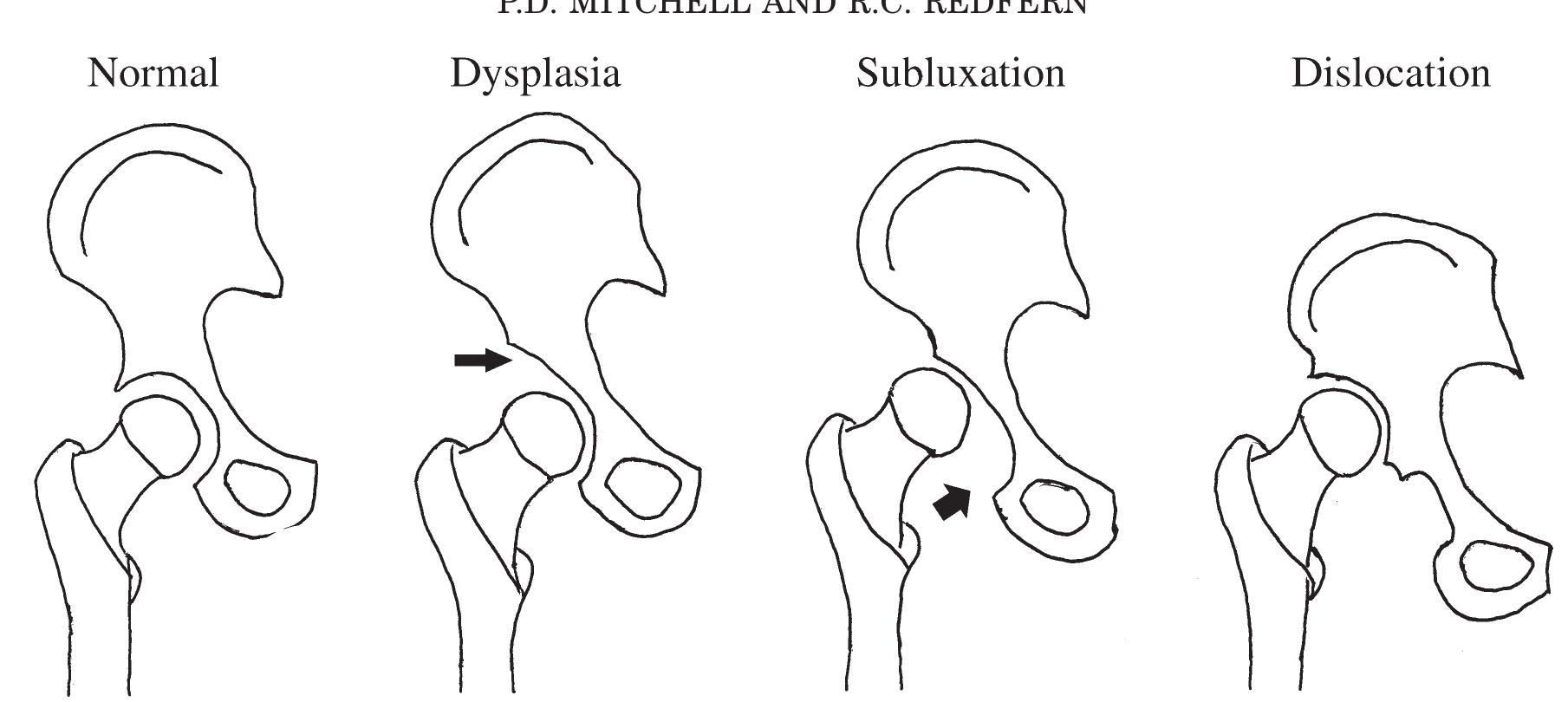 Genetic Dislocation Figure 5 - from Palaeopathological and palaeogenetic study