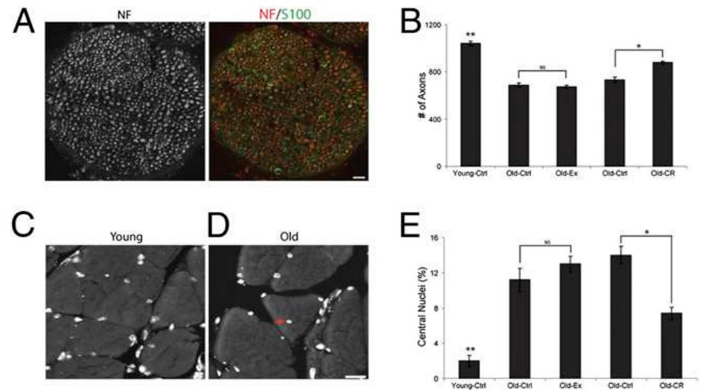 Loss of motor axons and regeneration of muscle fibers in