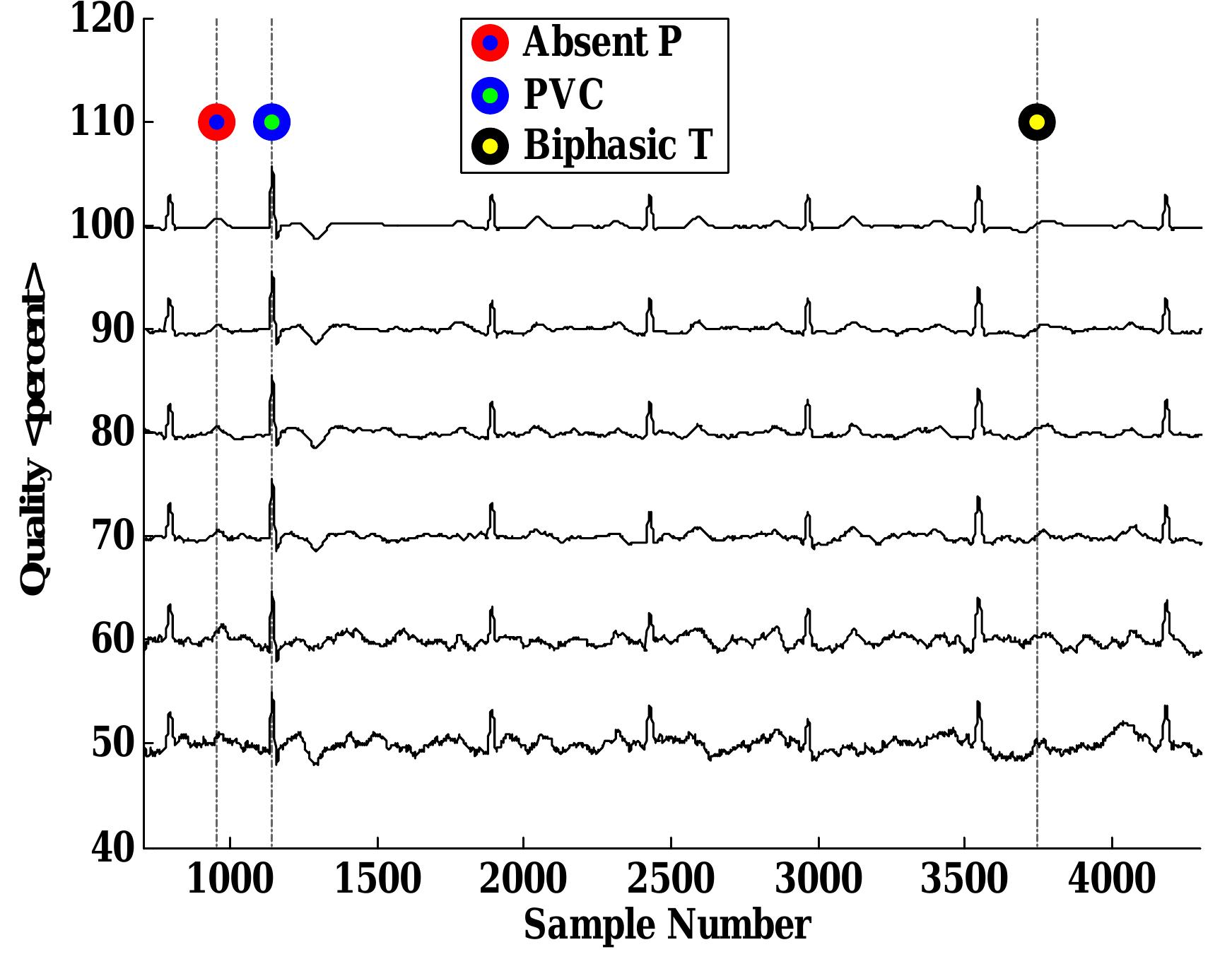 (PDF) A Correlation Analysis-based Detection and Delineation of ECG ...