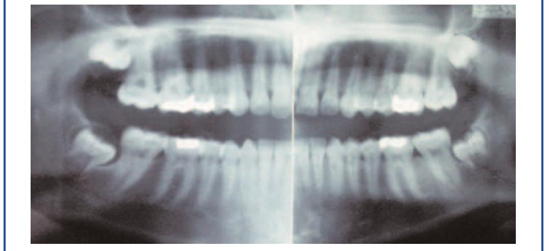 Figure 2 - from The Prophylactic Extraction of Third Molars: