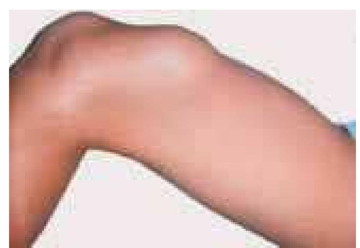 Figure 3 - from WHO Classification of Bone Tumours
