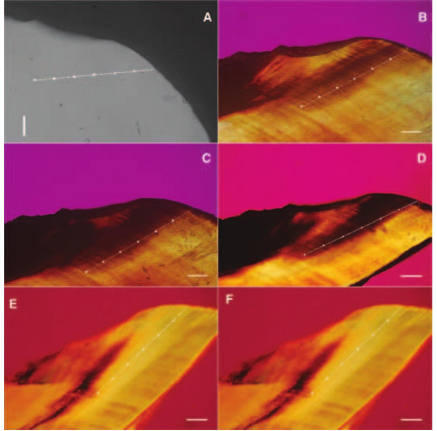 Images of caries lesion 1 (including the transverse with