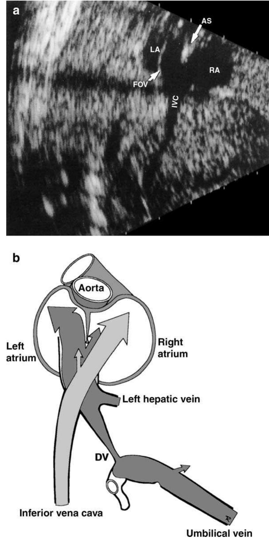 Inlet Scan Position (a) the ductus arteriosus (arrow) is a sizeable connection