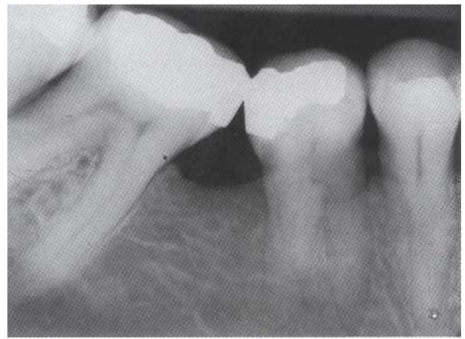 Premolar Roots Radiograph -38 radiographic appearance of a fast break in the