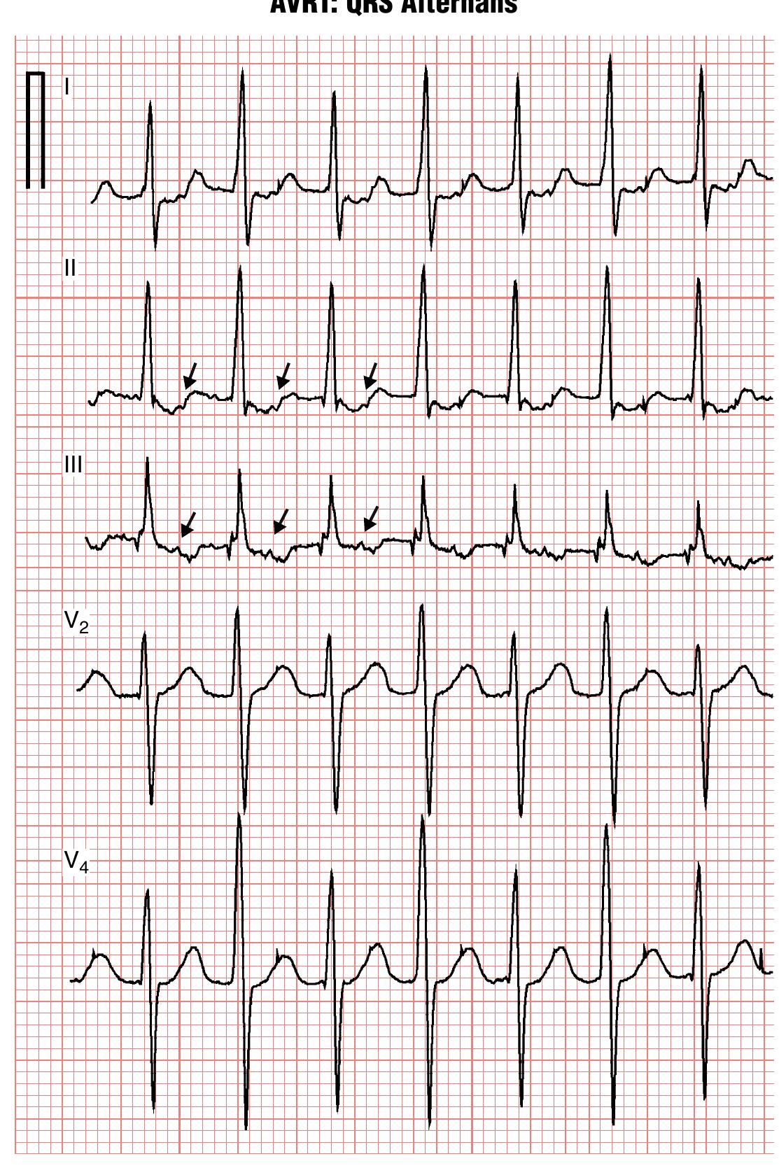 Figure 157 - from Goldbergers clinical electrocardiography a