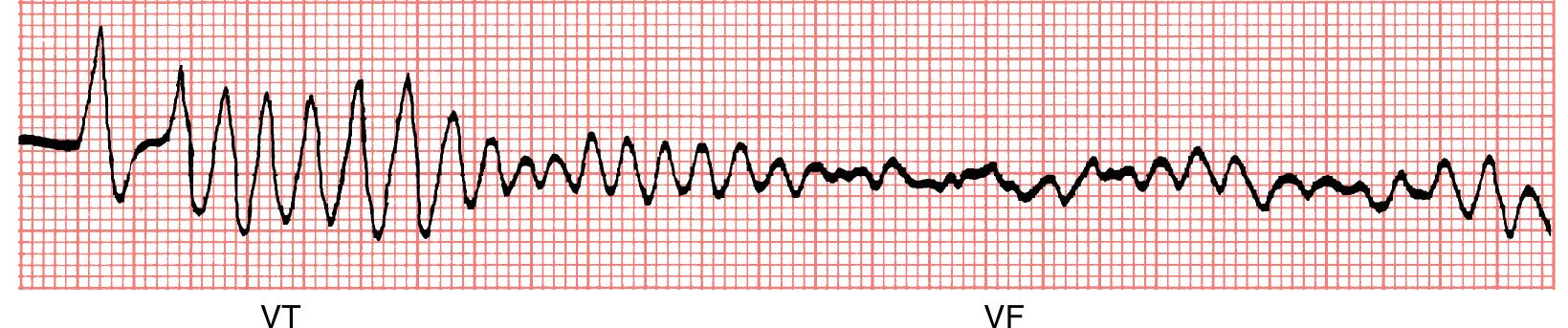 Vf Wave Figure 219 - from Goldbergers clinical electrocardiography a