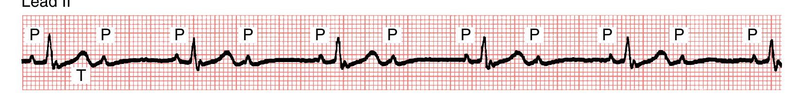 -16. the underlying rhythm is second-degree (2:1) av block.