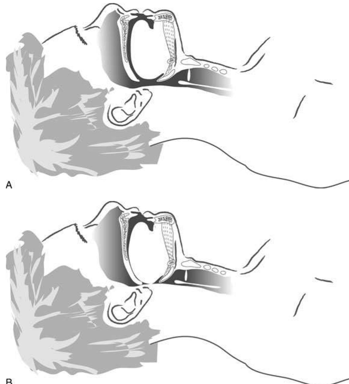 Obtunded Example Figure 46 - from Airway Management in Emergencies