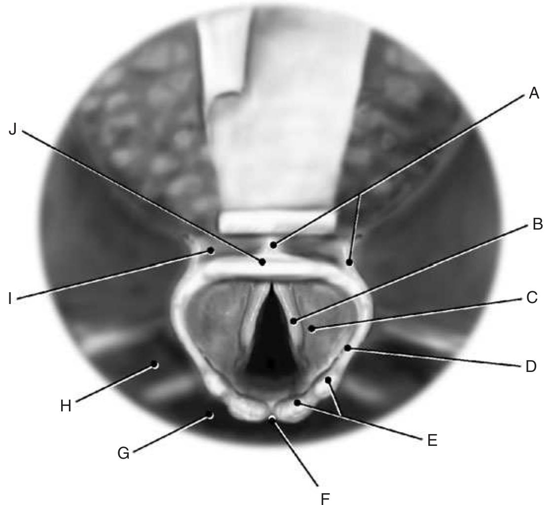 False Fold Overview Figure 36 - from Airway Management in Emergencies