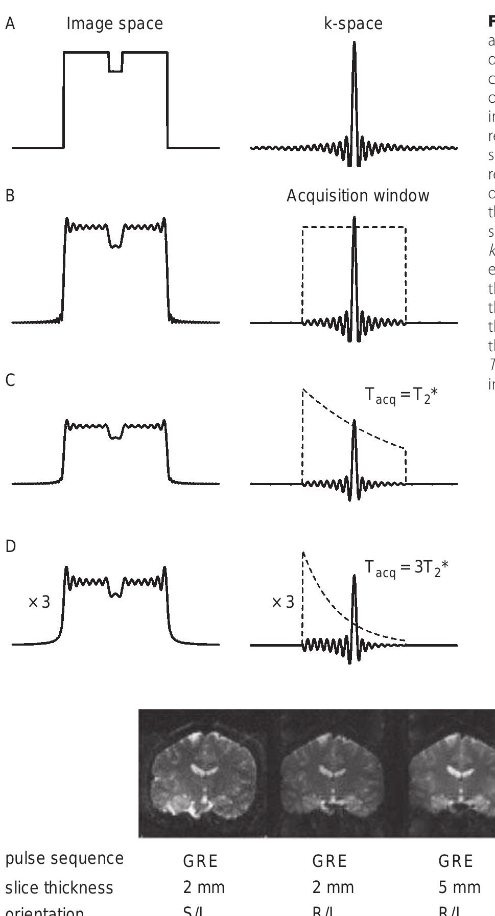 7. signal dropouts in echo planar imaging. in regions of