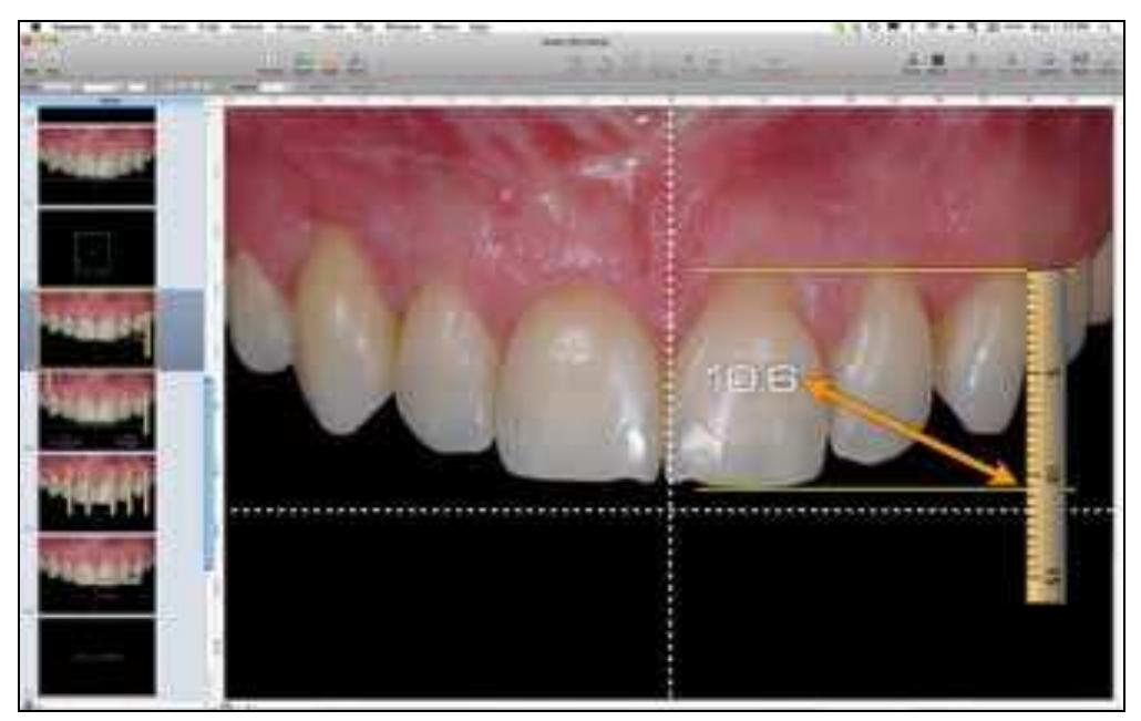 Digital Smile Design: A Tool for Treatment Planning and Communication ...