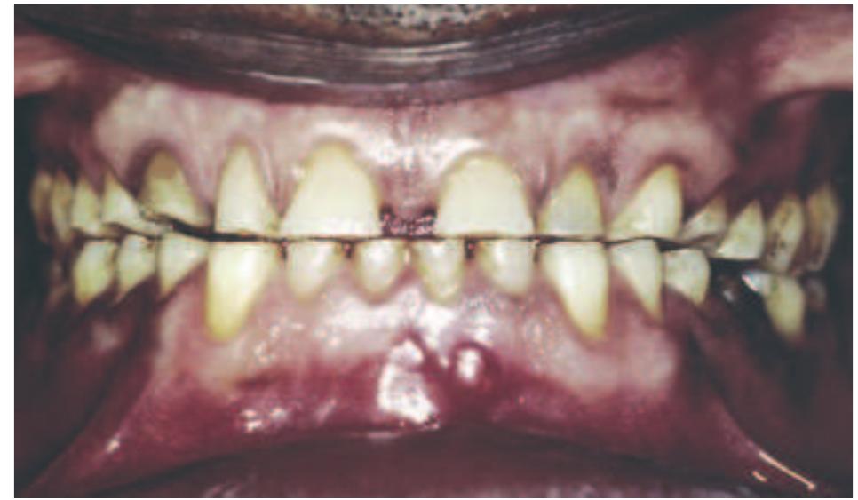 Development of an ‘edge-to-edge’ bite in a contemporary 50