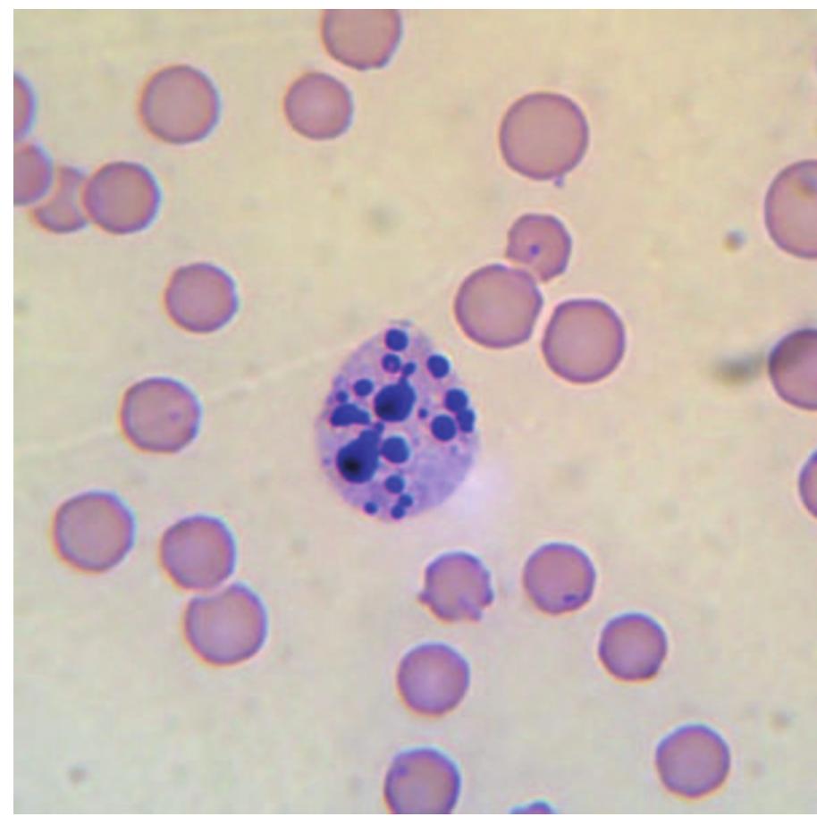 E 5.20 pyknotic neutrophil displaying karyorrhexis.